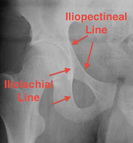 Acetabulum Ilioischial Iliopectineal Lines